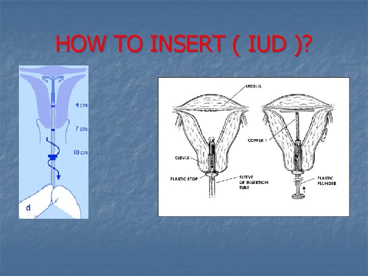 HOW TO INSERT ( IUD )? 