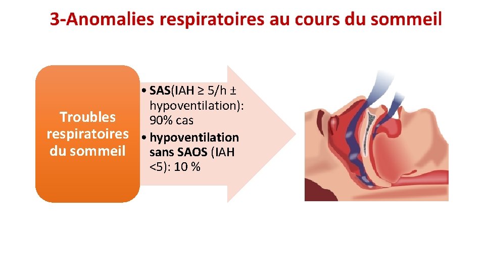  • SAS(IAH ≥ 5/h ± hypoventilation): Troubles 90% cas respiratoires • hypoventilation du