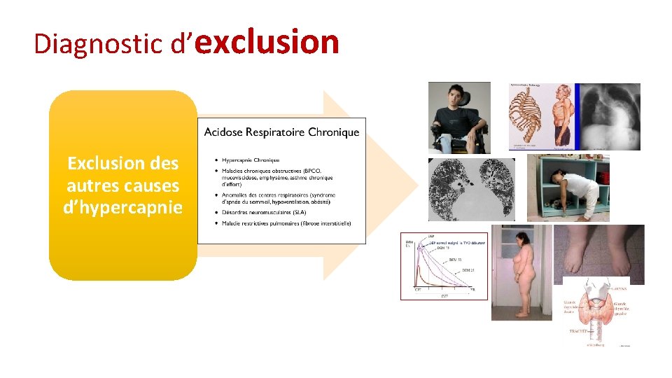 Diagnostic d’exclusion Exclusion des autres causes d’hypercapnie 