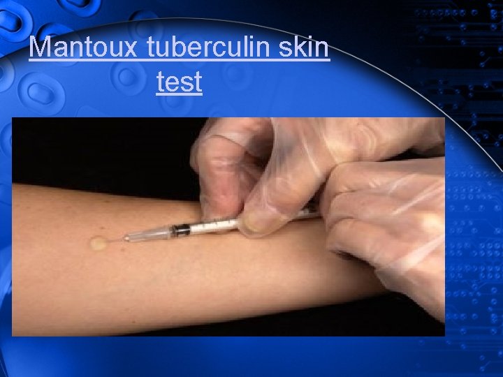 Mantoux tuberculin skin test 