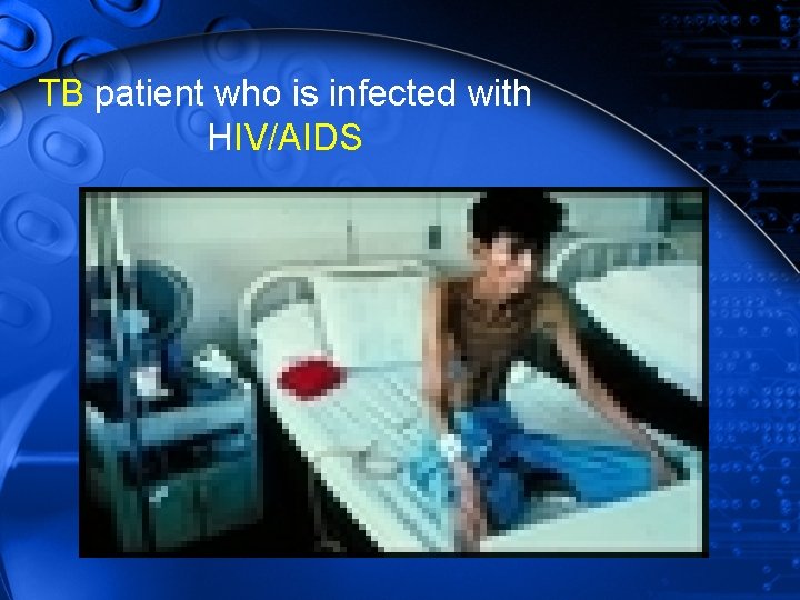 TB patient who is infected with HIV/AIDS 