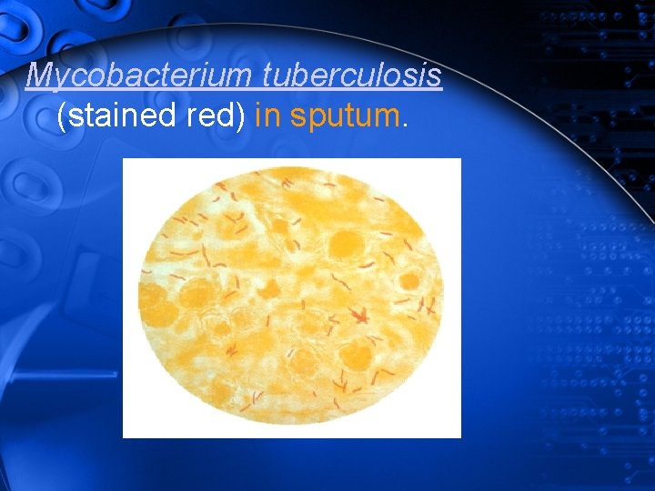 Mycobacterium tuberculosis (stained red) in sputum. 