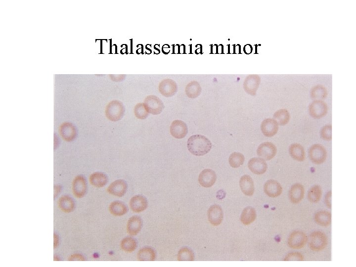 Thalassemia minor 