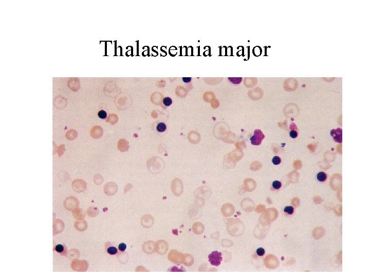 Thalassemia major 
