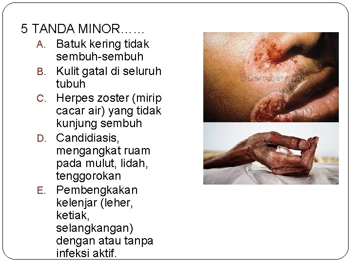 5 TANDA MINOR…… A. Batuk kering tidak B. C. D. E. sembuh-sembuh Kulit gatal