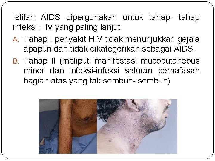 Istilah AIDS dipergunakan untuk tahap- tahap infeksi HIV yang paling lanjut A. Tahap I