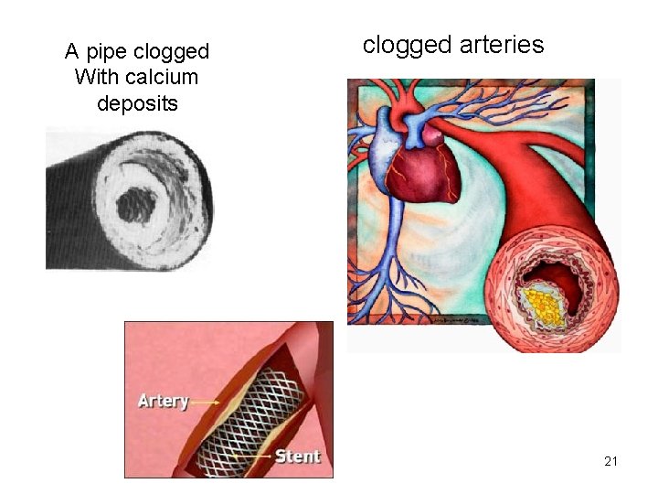 A pipe clogged With calcium deposits clogged arteries 21 