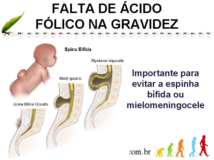 FALTA DE ÁCIDO FÓLICO NA GRAVIDEZ Importante para evitar a espinha bífida ou mielomeningocele