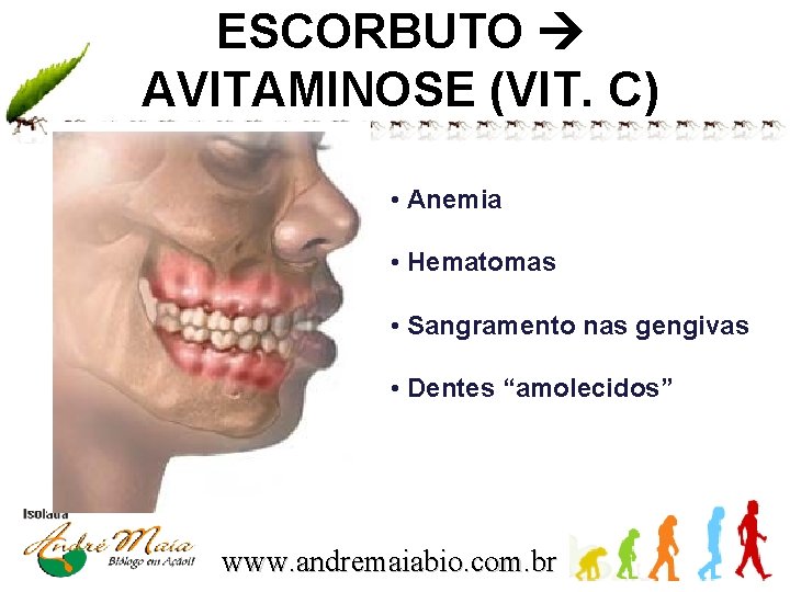 ESCORBUTO AVITAMINOSE (VIT. C) • Anemia • Hematomas • Sangramento nas gengivas • Dentes