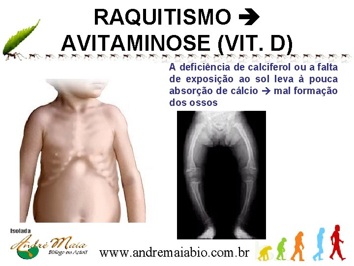 RAQUITISMO AVITAMINOSE (VIT. D) A deficiência de calciferol ou a falta de exposição ao