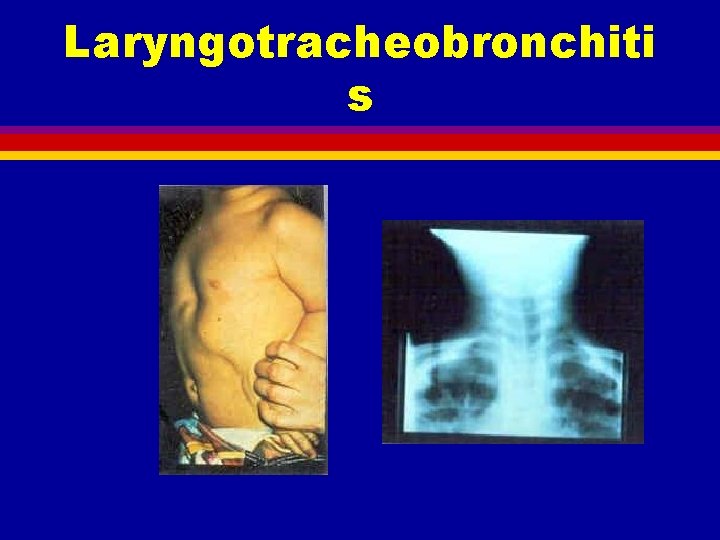 Laryngotracheobronchiti s 