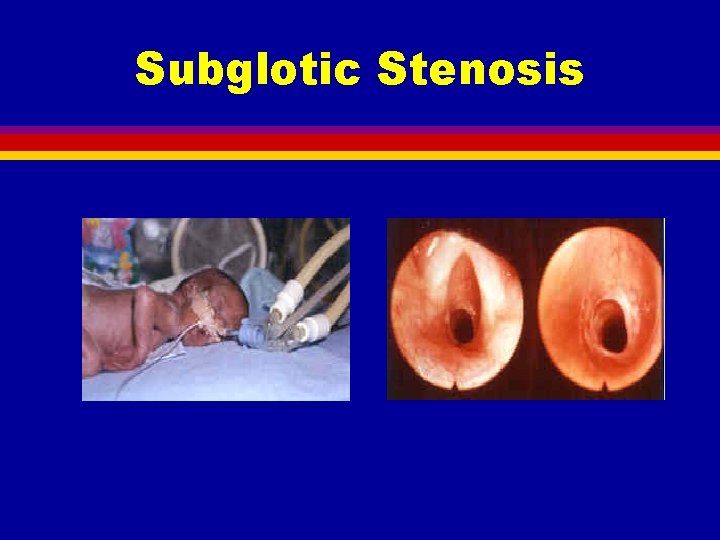 Subglotic Stenosis 