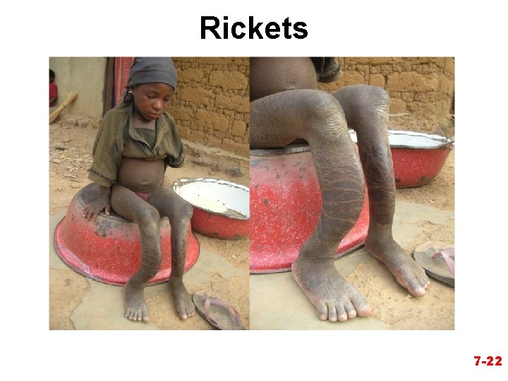 Rickets 7 -22 
