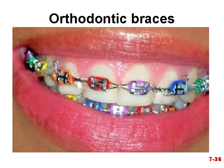 Orthodontic braces 7 -36 