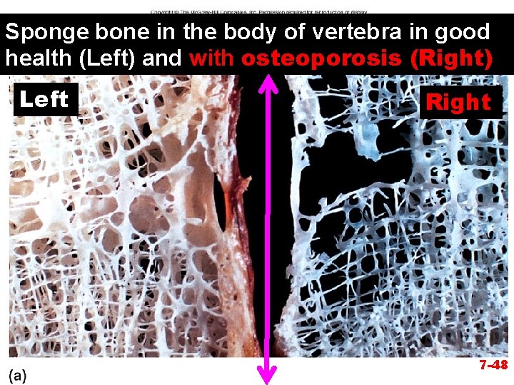 Sponge bone in the body of vertebra in good health (Left) and with osteoporosis
