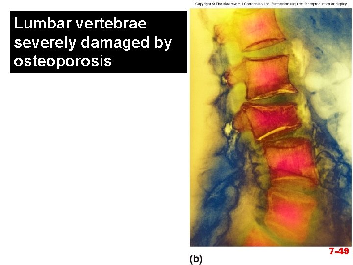 Lumbar vertebrae severely damaged by osteoporosis 7 -49 
