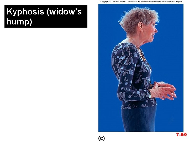 Kyphosis (widow’s hump) 7 -50 
