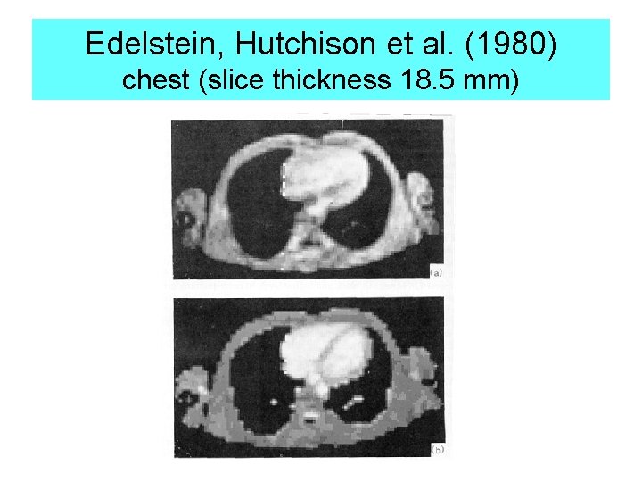 Edelstein, Hutchison et al. (1980) chest (slice thickness 18. 5 mm) 