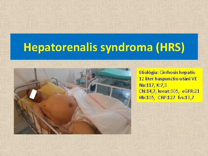 Hepatorenalis syndroma (HRS) Etiológia: Cirrhosis hepatis 12 liter haspunctio utáni VE Na: 117, K: