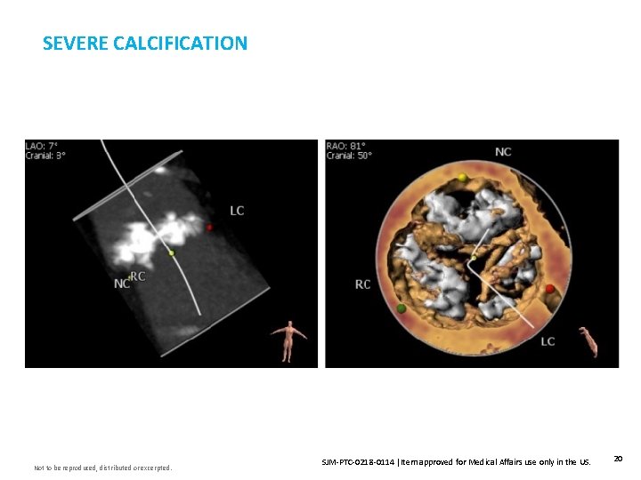 SEVERE CALCIFICATION Not to be reproduced, distributed or excerpted. SJM-PTC-0218 -0114 Item approved for