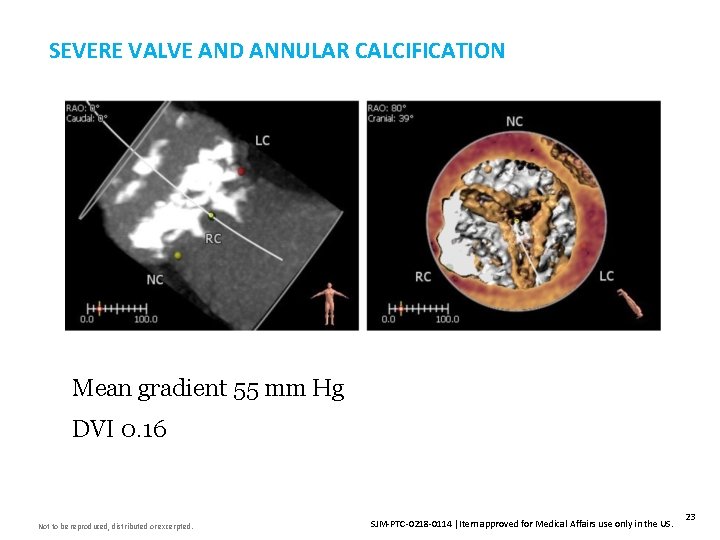 SEVERE VALVE AND ANNULAR CALCIFICATION Insert Image Here Mean gradient 55 mm Hg DVI