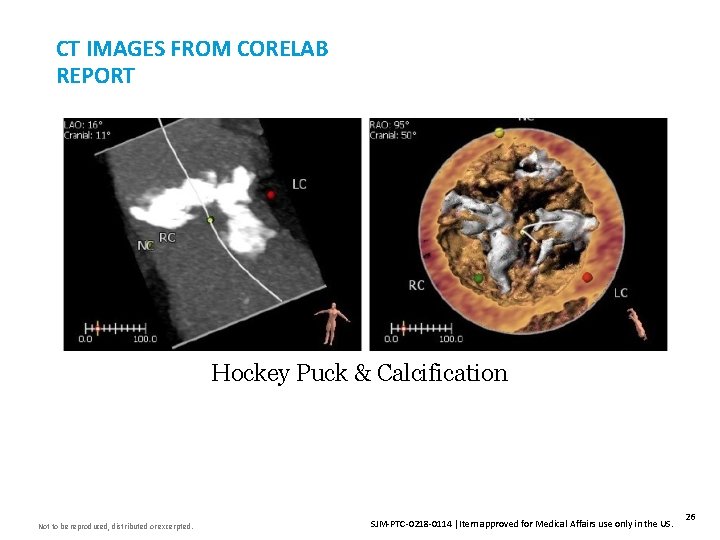 CT IMAGES FROM CORELAB REPORT Insert Image Here Hockey Puck & Calcification Not to