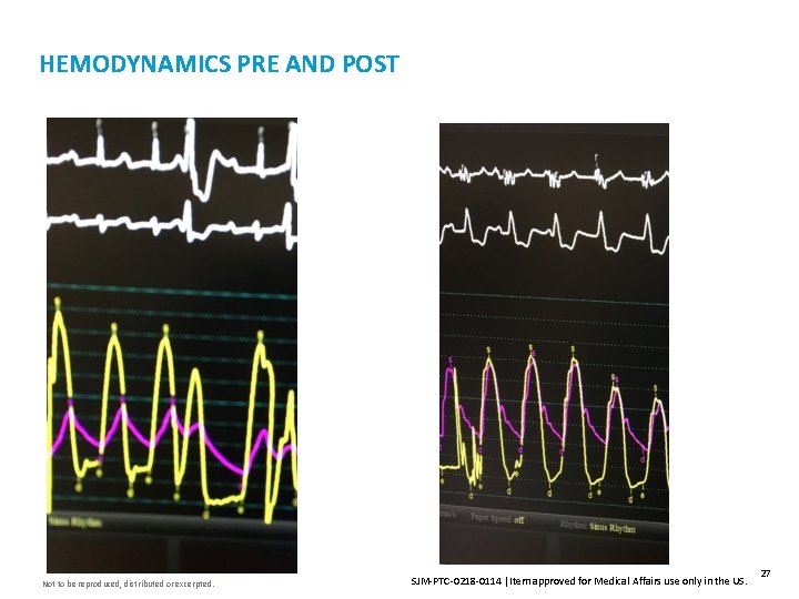 HEMODYNAMICS PRE AND POST Not to be reproduced, distributed or excerpted. SJM-PTC-0218 -0114 Item