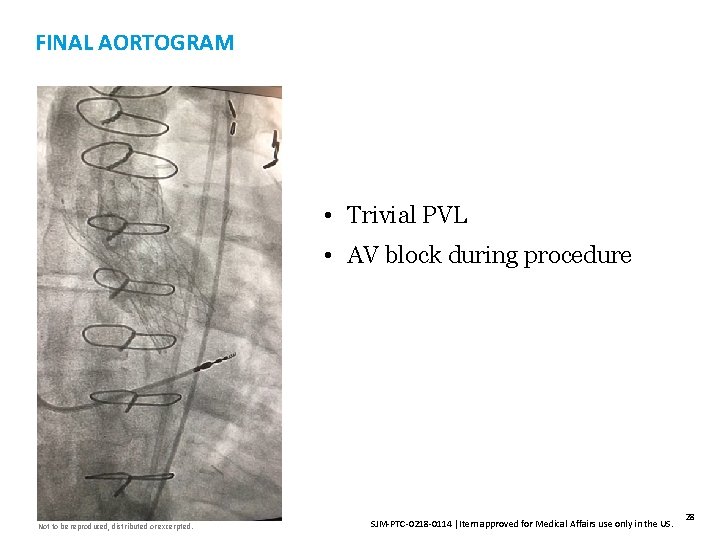 FINAL AORTOGRAM • Trivial PVL • AV block during procedure Not to be reproduced,