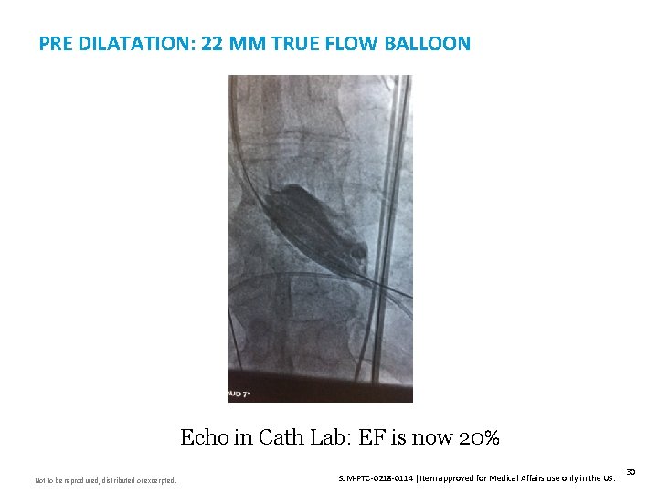 PRE DILATATION: 22 MM TRUE FLOW BALLOON Echo in Cath Lab: EF is now