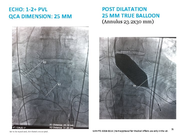 ECHO: 1 -2+ PVL QCA DIMENSION: 25 MM Not to be reproduced, distributed or
