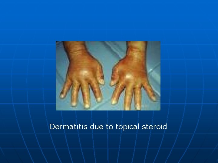 Dermatitis due to topical steroid 