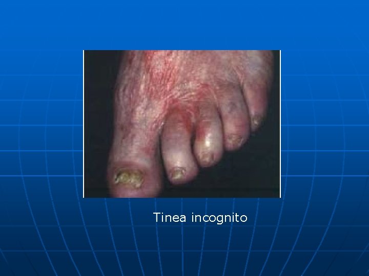 Tinea incognito 
