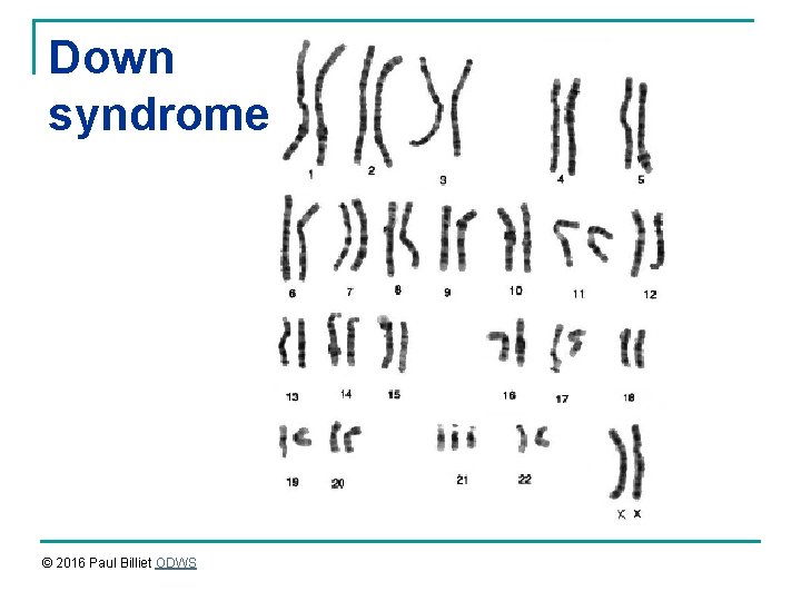 Down syndrome © 2016 Paul Billiet ODWS 