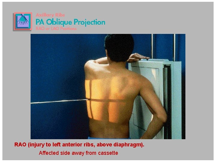 RAO (injury to left anterior ribs, above diaphragm). 13 Affected side away from cassette RAO (injury to left anterior ribs, above diaphragm). 13 Affected side away from cassette