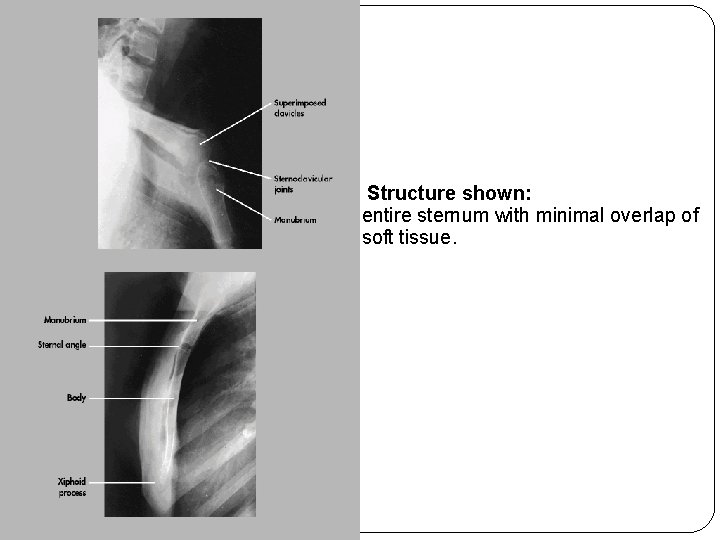 Structure shown: entire sternum with minimal overlap of soft tissue. Structure shown: entire sternum with minimal overlap of soft tissue.