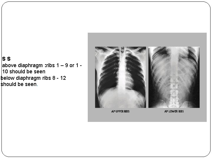 SS above diaphragm : ribs 1 – 9 or 1 10 should be seen SS above diaphragm : ribs 1 – 9 or 1 10 should be seen