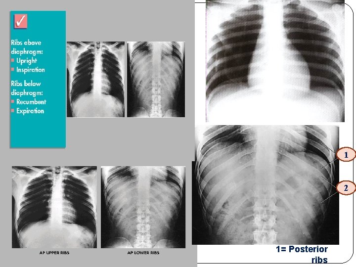 1 2 1= Posterior ribs 