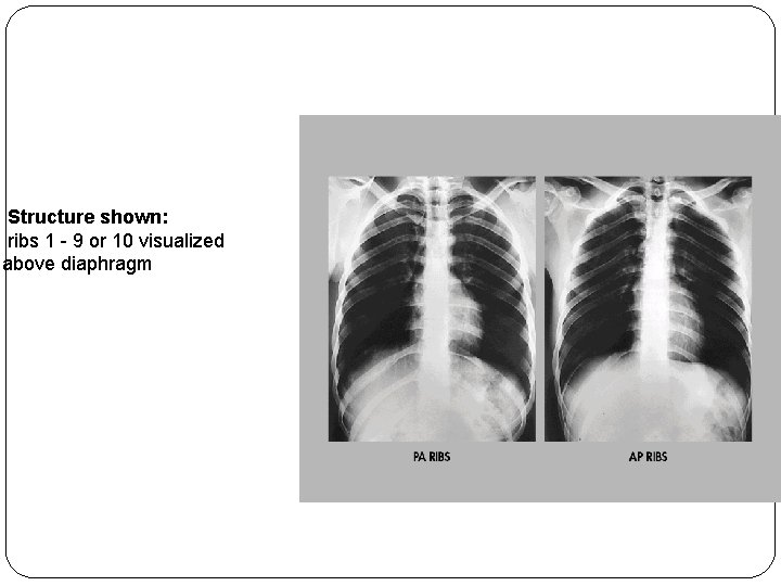 Structure shown: ribs 1 - 9 or 10 visualized above diaphragm 