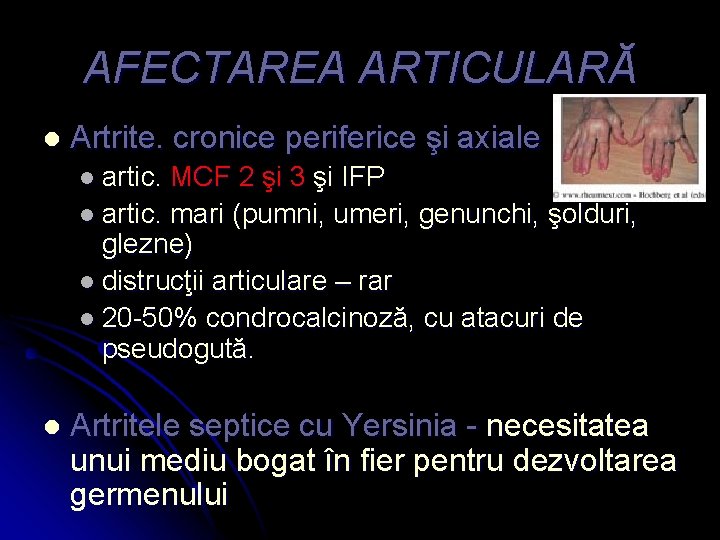 AFECTAREA ARTICULARĂ l Artrite. cronice periferice şi axiale l artic. MCF 2 şi 3
