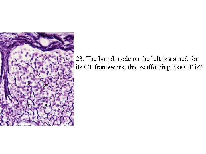 23. The lymph node on the left is stained for its CT framework, this