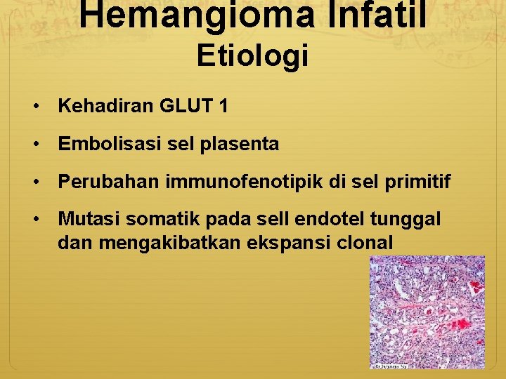 Hemangioma Infatil Etiologi • Kehadiran GLUT 1 • Embolisasi sel plasenta • Perubahan immunofenotipik