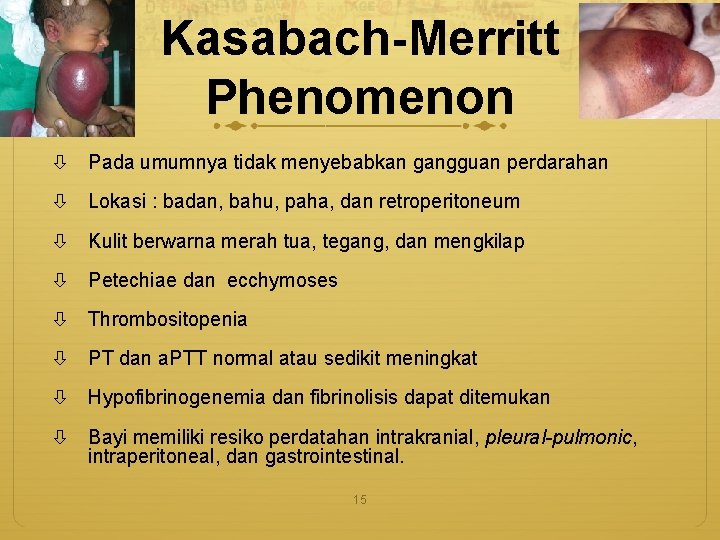 Kasabach-Merritt Phenomenon Pada umumnya tidak menyebabkan gangguan perdarahan Lokasi : badan, bahu, paha, dan