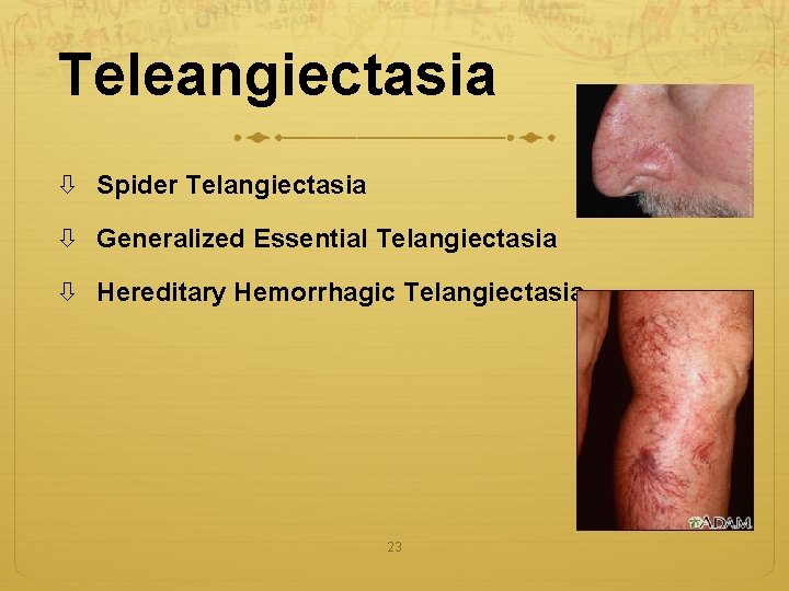 Teleangiectasia Spider Telangiectasia Generalized Essential Telangiectasia Hereditary Hemorrhagic Telangiectasia 23 