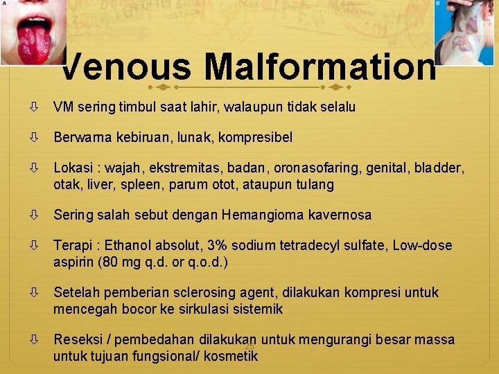 Venous Malformation VM sering timbul saat lahir, walaupun tidak selalu Berwarna kebiruan, lunak, kompresibel