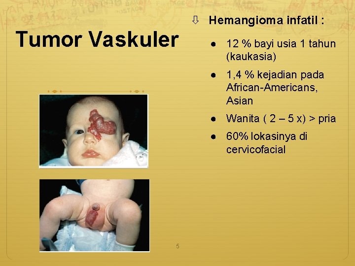  Hemangioma infatil : Tumor Vaskuler ● 12 % bayi usia 1 tahun (kaukasia)