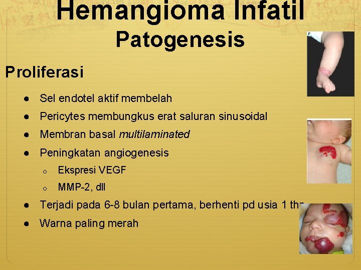 Hemangioma Infatil Patogenesis Proliferasi ● Sel endotel aktif membelah ● Pericytes membungkus erat saluran