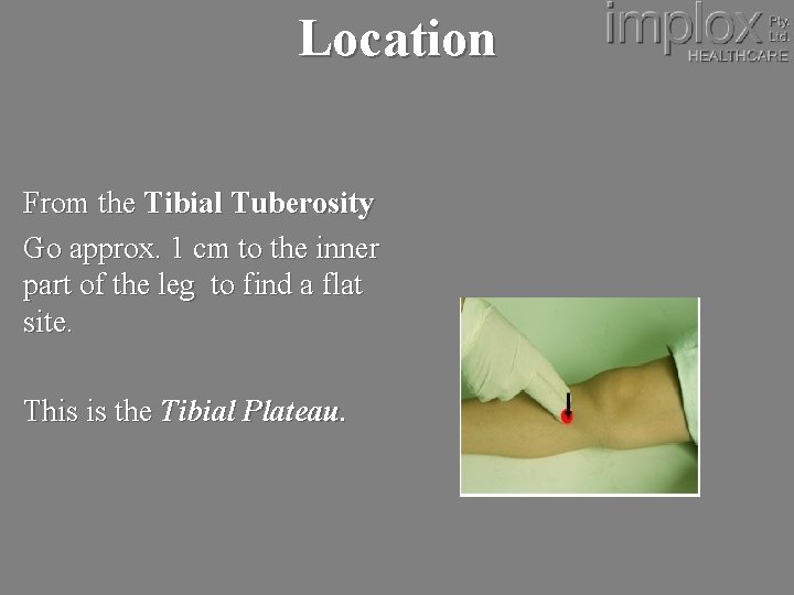 Location From the Tibial Tuberosity Go approx. 1 cm to the inner part of