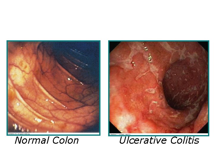 Normal Colon Ulcerative Colitis 