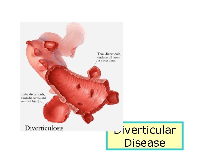 Diverticular Disease 