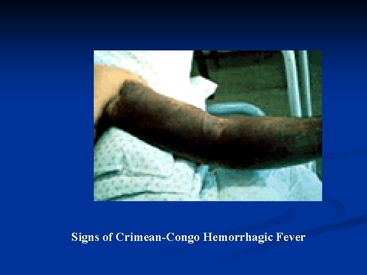 Signs of Crimean-Congo Hemorrhagic Fever 